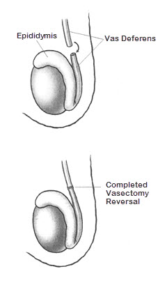 Timeframe for Getting Pregnant After a Vasectomy Reversal