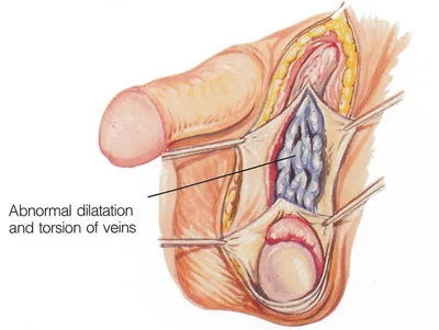  80 Day - Varicocele Home Treatment Program : Health