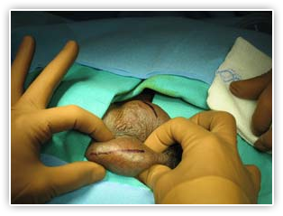 Vasectomy Reversal Procedure  Images of a Reverse Vasectomy