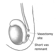 vasectomy site close to the testicle