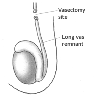 good vasectomy site: disconnected vas deferens farther away from the testicle